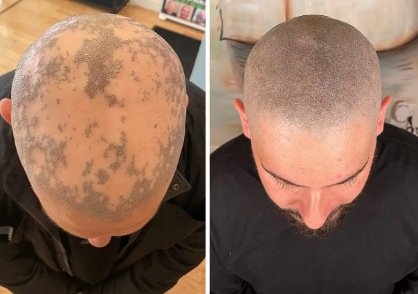 alopecia.webp