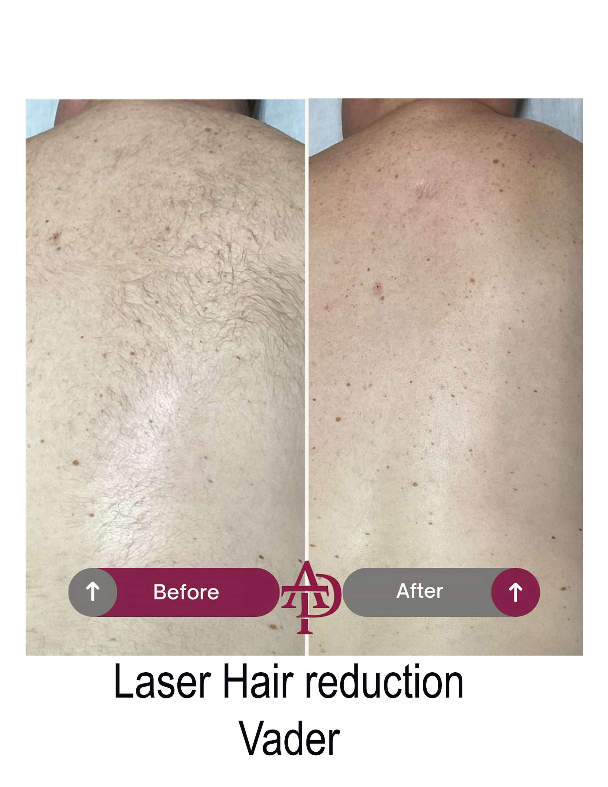 apthairback11x